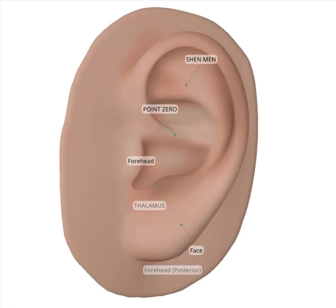 Example Protocol for Bell's Palsy, shown on a 3D ear in Auriculo 360.